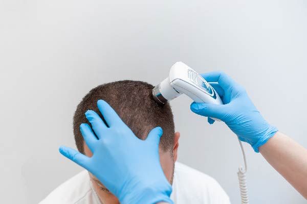 Androgene Alopezie: Welche Therapien helfen?