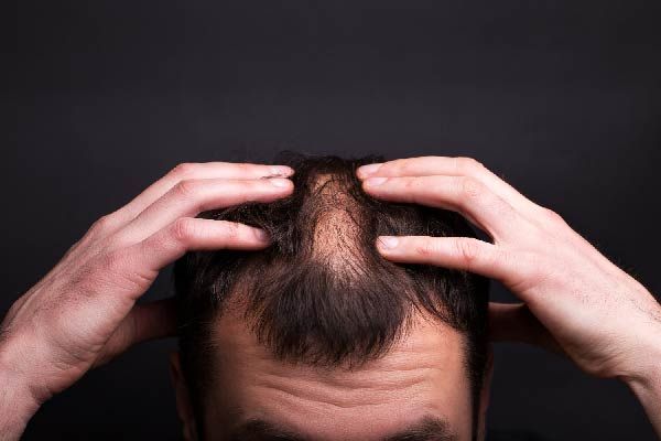 Androgene Alopezie: Was sind die Ursachen