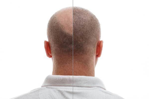 Tipps nach Haartransplantation: Hygienepflege der Kopfhaut