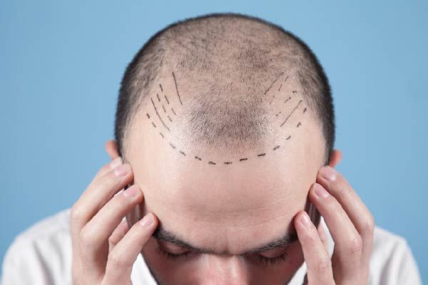 Tipps nach Haartransplantation: Medikamente