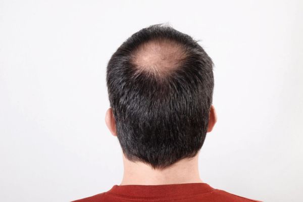 Haartransplantation