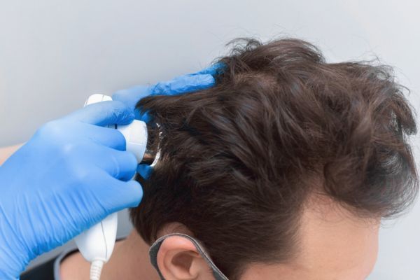 Kostenvergleich für Haartransplantationen in der Türkei
