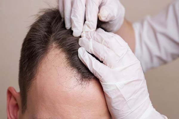 Wie bereitet man sich auf den Eingriff vor Wie kann man Eingriffe für Haarimplantate verbergen Berühmte Persönlichkeiten Haartransplantation - FUE-Technik Türkei