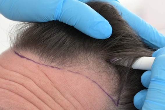 Die Türkei ist internationaler Spitzenreiter bei der Haarveredelung1