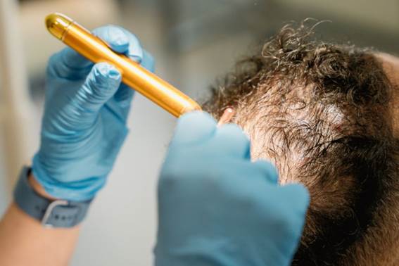 Die Türkei ist internationaler Spitzenreiter bei der Haarveredelung2