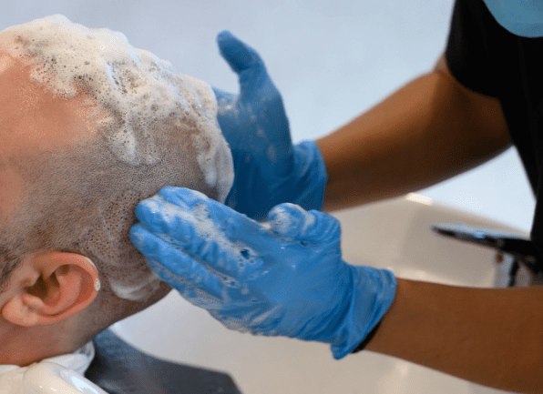 Stammzellen und Haarausfall3