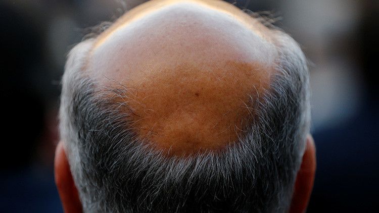 anti-hair shampoo Haartransplantation für glatzköpfige Menschen