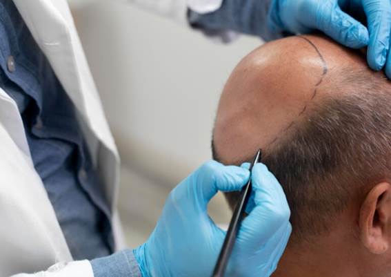 haartransplantation in der Beste Klinik Haartransplantation Madrid