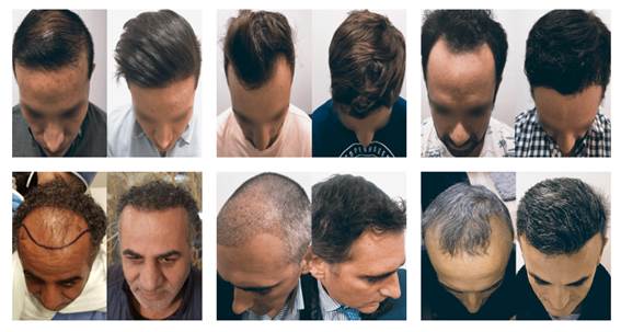 vor und nach der Haartransplantation in der besten Klinik - nach einer Haartransplantation