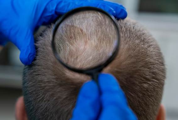 Behandlungsmöglichkeiten bei dünner werdendem Haar