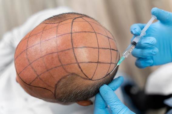 Haartransplantation