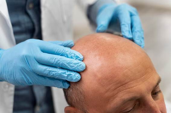 Was sind die Warnzeichen für Haarausfall?