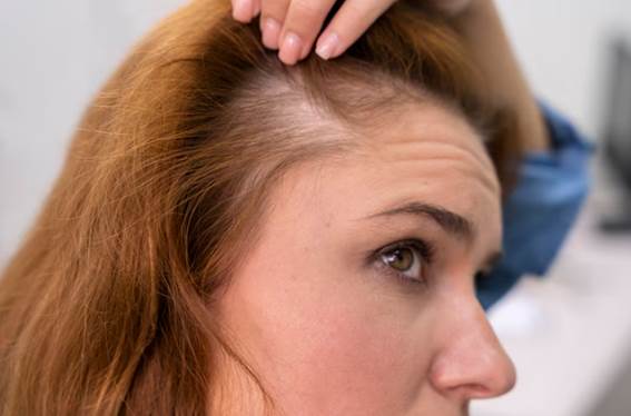 Androgenetische Alopezie