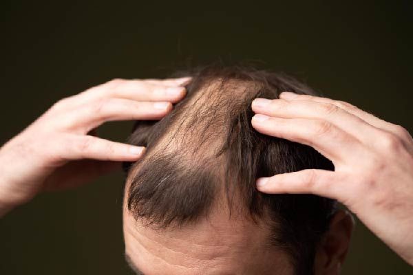 Behandlungen für Alopezie areata
