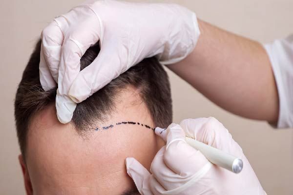 Chirurgie für Haartransplantation