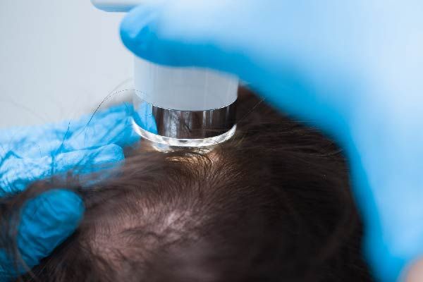 Diagnose von Alopecia Areata