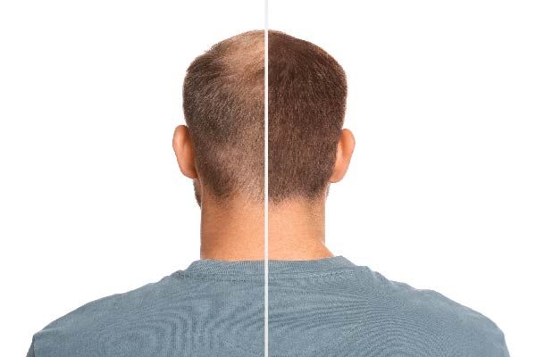 Haarimplantat nach der FUE-Transplantationstechnik