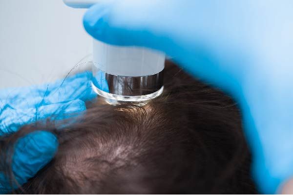 Was ist die FUE-Haartransplantation 