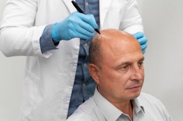 Arzt zeichnet auf den kahlen Kopf eines Patienten, der sich einer Haartransplantation unterziehen wird