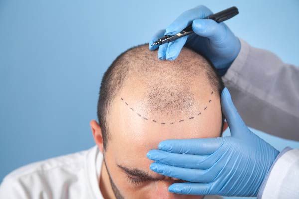 FUE-Methode - Haartransplantation und Stammzellenbehandlung