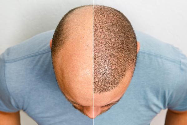 Haartransplantation und Stammzellenbehandlung