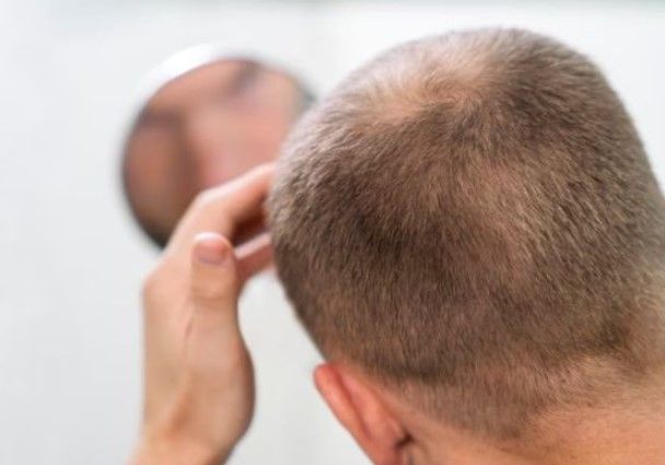 Mann der bereit ist verlorenes haar wiederherzustellen