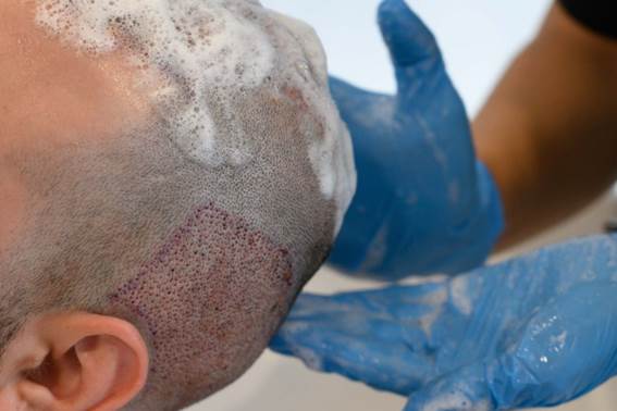 Haartransplantation in Berlin