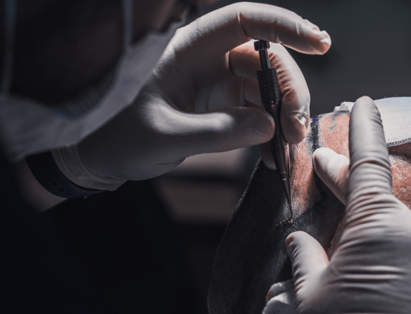 Nahaufnahme einer Haartransplantation Berlin