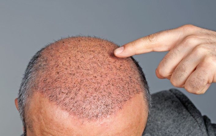 Haarimplantate bei Haartransplantation - Entwicklung der Haartransplantation