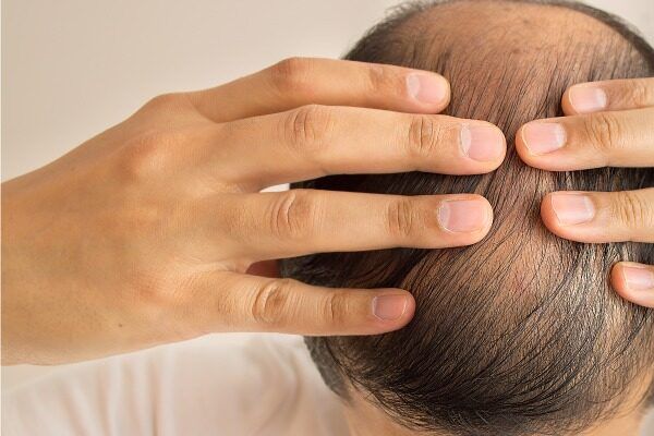 beste haartransplantation Deutschland