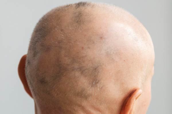 Behandlung von Alopecia Areata