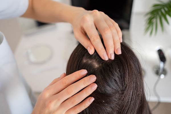 Haarprobleme verschiedene als Alopezie: Schuppen