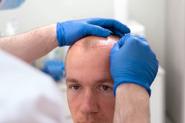 Nachsorge nach der Haartransplantation