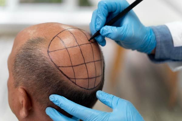 Ursachen des frontalen Haarausfalls