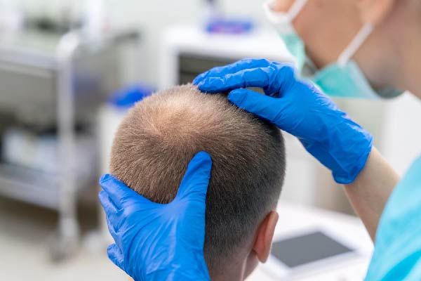 Haarausfall (Alopezie)