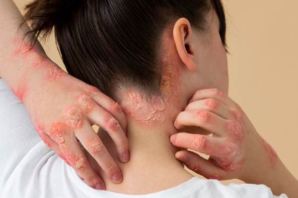 Seborrhoische Dermatitis