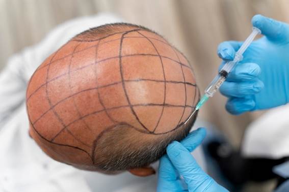 Was haartransplantation Türkei kosten