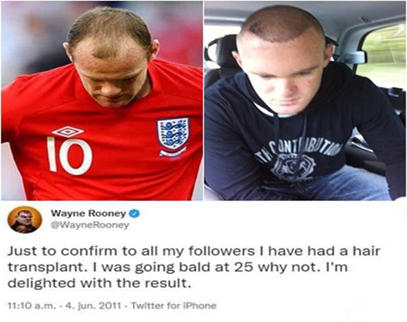 Wayne Rooney - Berühmtheiten Haartransplantationen