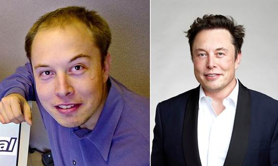 Elon Musk - Berühmtheiten Haartransplantationen