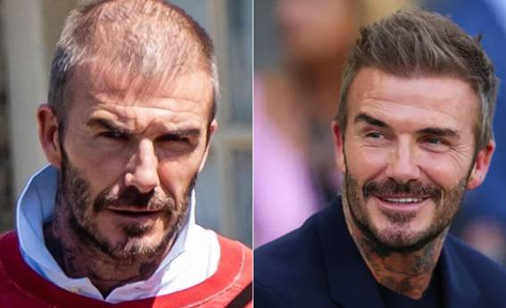 David Beckham Prominente, die eine Haartransplantation hatten