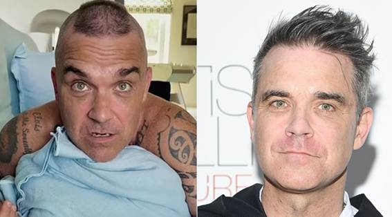 Robbie Williams die eine Haartransplantation hatten