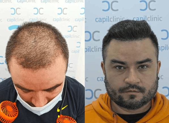 vor und nach der Haartransplantation ohne Rasur