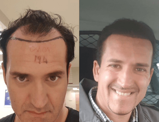Vor und nach einer Haartransplantation ohne Rasur