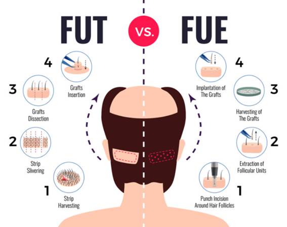 FUE vs FUT - Haartransplantation ohne Rasur