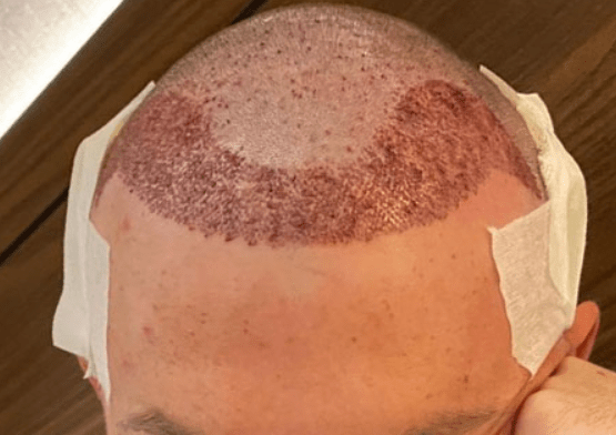 Haartransplantation vorher und nachher - Nachsorge nach einer Haartransplantation