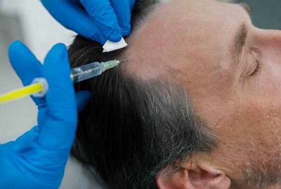 Haartransplantation ohne Rasur
