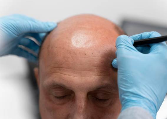 Haartransplantation dauerhaft